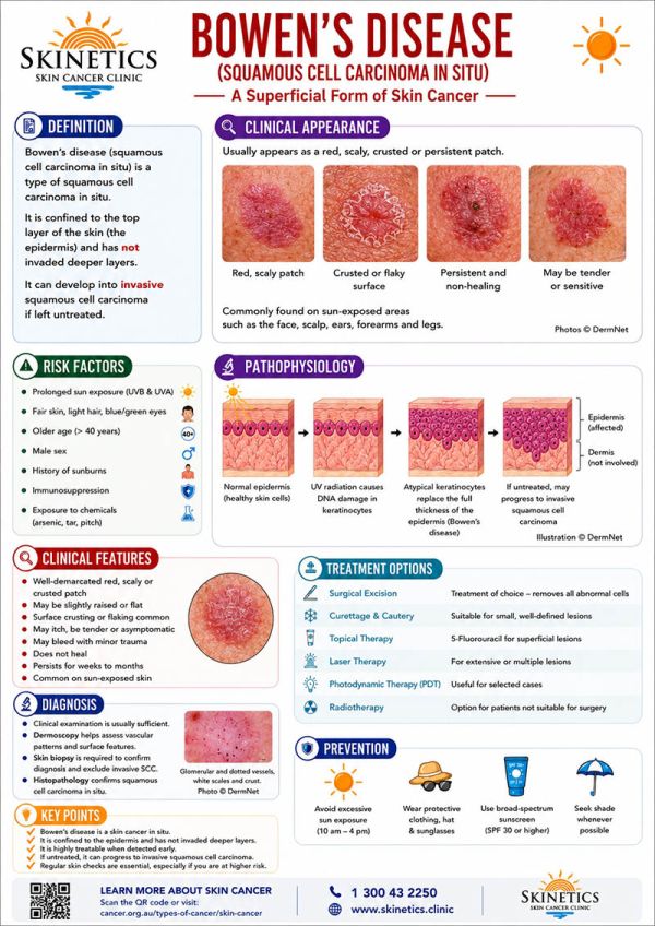 skinetics-bowens-disease-poster-a4-final03875032-9030-D60C-5EE2-37B58730755C.jpg