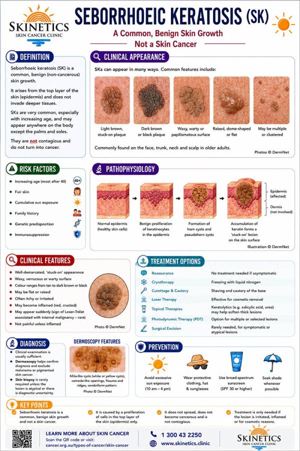 skinetics-seborrhoeic-keratosis-poster-a4-finalD8D1D6B1-E91F-D584-458B-FEA1F557500C.jpg